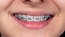 Does your kid really need braces?