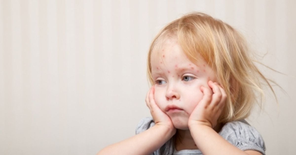 Pox talk the pros and cons of the varicella vaccine Today's Parent