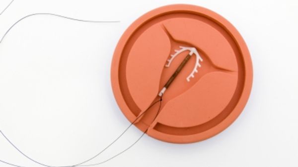 Birth control: IUD - Today's Parent