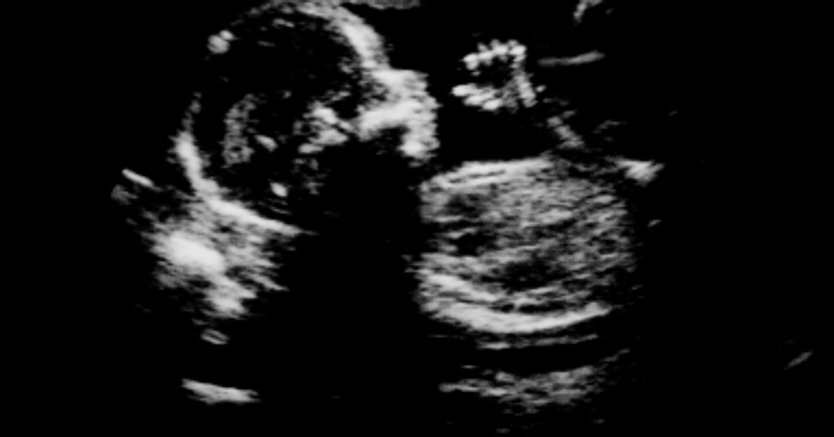 What you need to know about ultrasounds Today's Parent