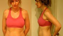 Diastasis recti: A case of "mommy tummy"