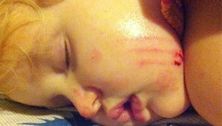 A dog bit my child in the face!