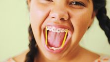 When your preteen needs braces