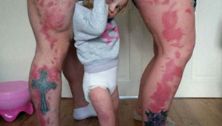 Parents get tattoos to match daughter's birthmark