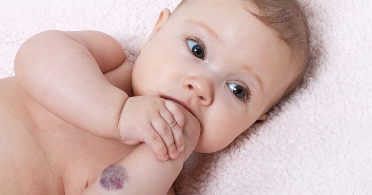 4 things you should know about hemangioma aka strawberry birth marks