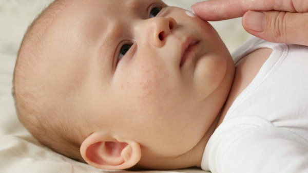 Rashes in kids: An age-by-age guide to children's skin conditions ...