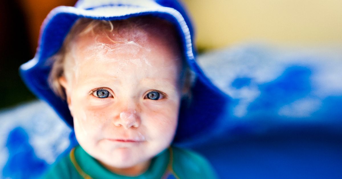 Sunscreens for kids may be linked to severe burns Today's Parent