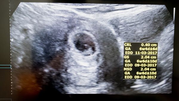 What to expect at your 6-week ultrasound appointment