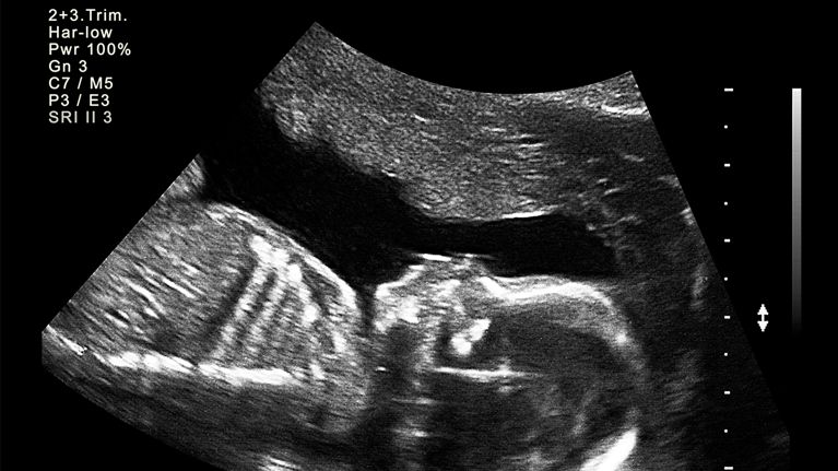 What To Expect At Your 20 week Ultrasound Appointment Today s Parent