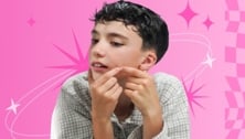Navigating Tween Acne